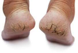 Deep heel cracks